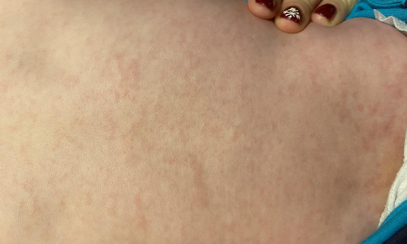 Tridienė karštinė ar alergija ?